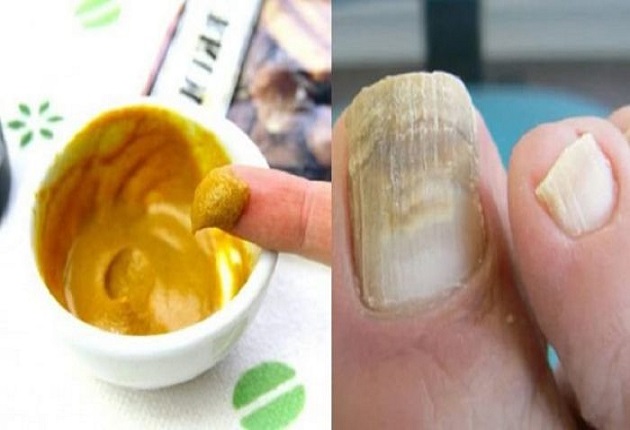 как се използва антифлегмин за гъбички по ноктите